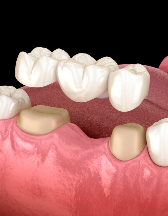 Dental Bridges