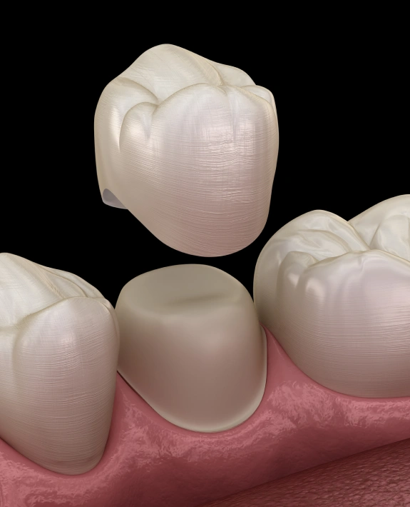 Dental Crowns