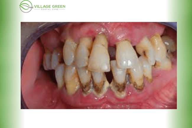 Advanced Stage of Gum Disease