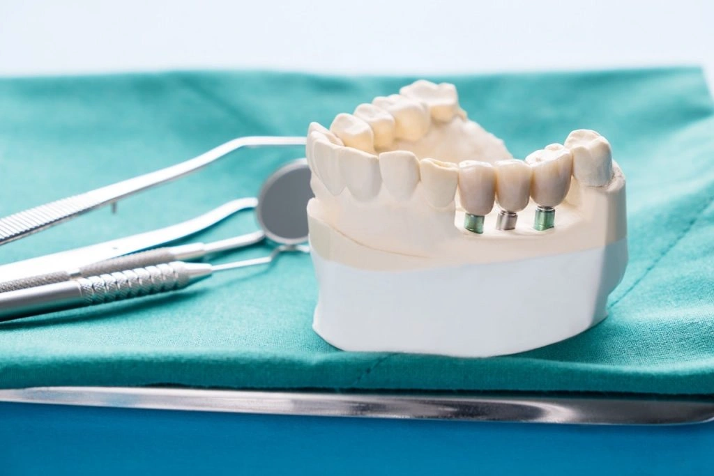 Implant-Supported Dentures