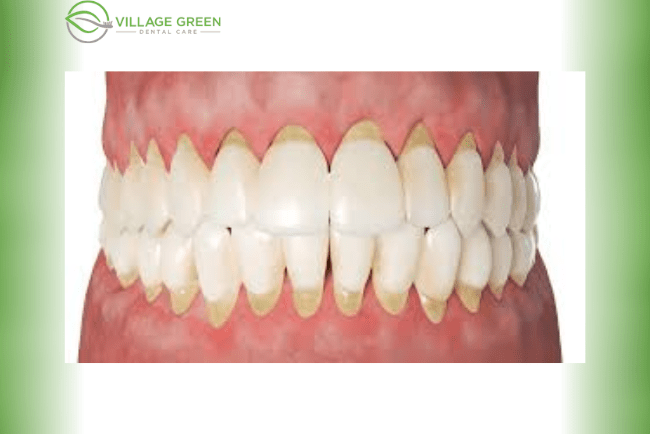 Mid-stage of Gum Disease
