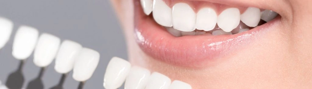Professional Teeth Whitening
