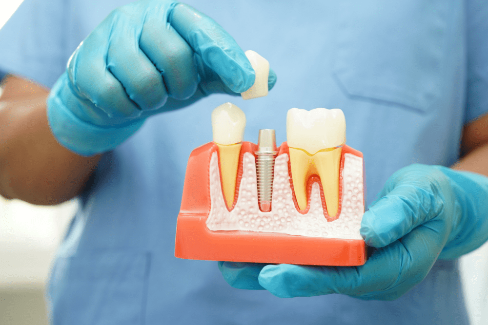 What Are Dental Implants