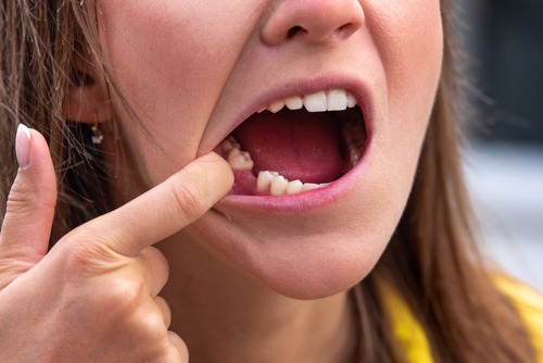 What to Avoid Immediately After the Procedure