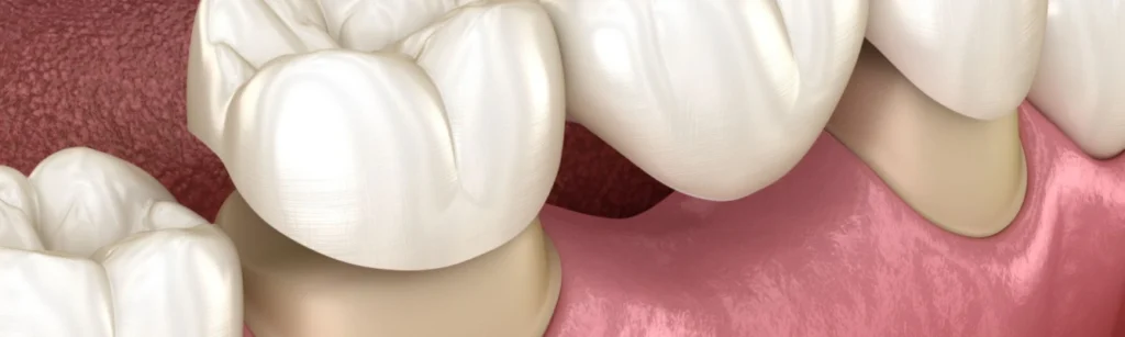 Dental Bridges