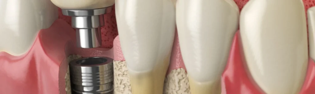 Dental Implants