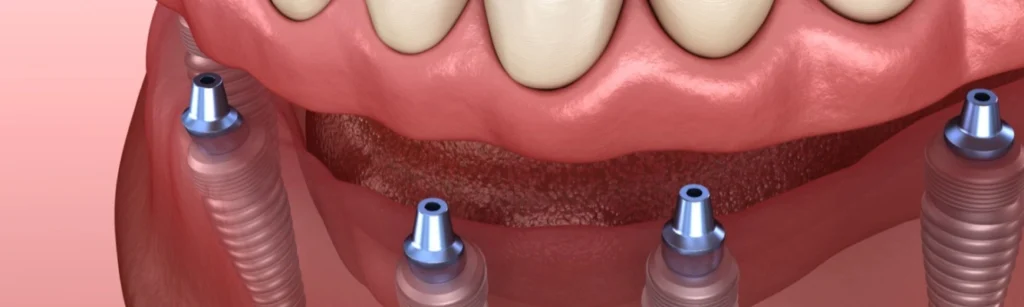 Dentures