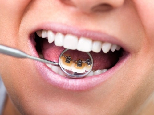 Lingual Braces