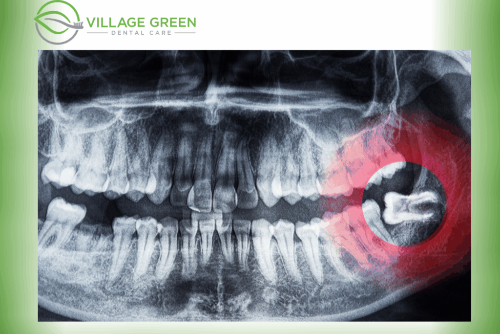 impacted wisdom teeth